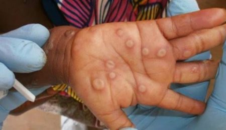 India Confirms First Case of New Mpox Strain Amid WHO Alert india-confirms-first-case-of-new-mpox-strain-amid-who-alert