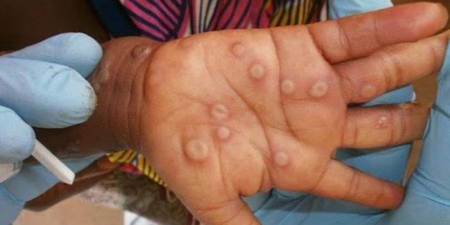 India Confirms First Case of New Mpox Strain Amid WHO Alert india-confirms-first-case-of-new-mpox-strain-amid-who-alert