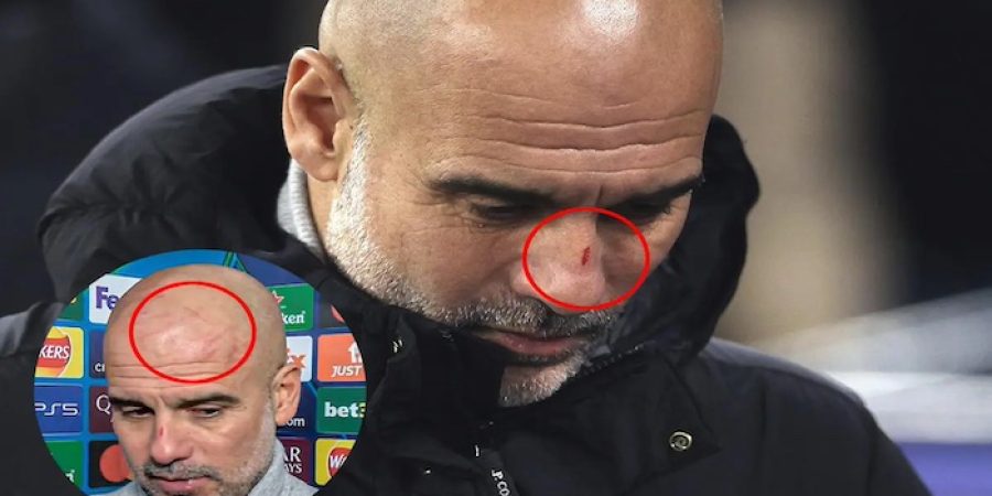 Guardiola Clarifies Comments on Self-Harm After Post-Match Joke About Scratches On His Face guardiola-clarifies-comments-on-self-harm-after-post-match-joke-about-scratches-on-his-face