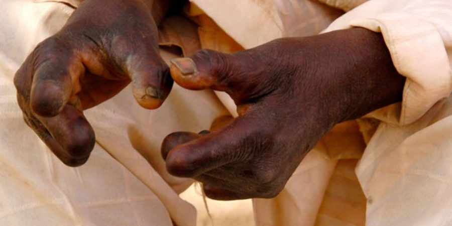 Human Rights Group Raises Alarm Over 3,000 Leprosy Patients Left Without Access To Drugs human-rights-group-raises-alarm-over-3,000-leprosy-patients-left-without-access-to-drugs